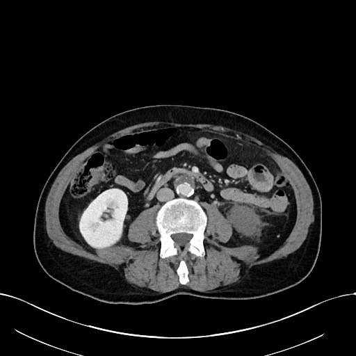 Acute renal infarction (Radiopaedia 59375-66736 Axial C+ portal venous phase 55).jpg