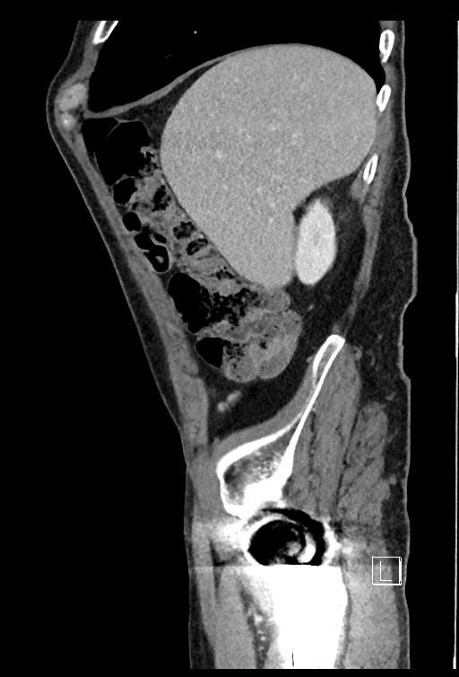 Acute renal infarction - rim capsular enhancement (Radiopaedia 59833-67270 Sagittal C+ portal venous phase 72).jpg