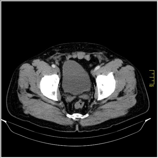 Acute right sided diverticulitis (Radiopaedia 65249-74268 Axial C+ portal venous phase 73).JPG