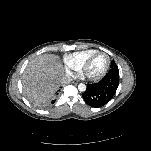 Acute segmental pulmonary emboli and pulmonary infarction (Radiopaedia 62264-70444 Axial C+ CTPA 87).jpg