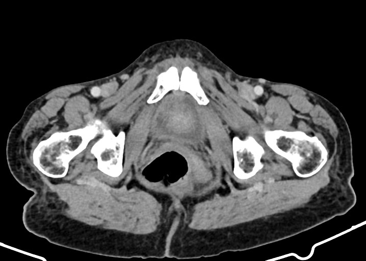 Acute small bowel (ileal) volvulus (Radiopaedia 71740-82139 Axial C+ portal venous phase 196).jpg