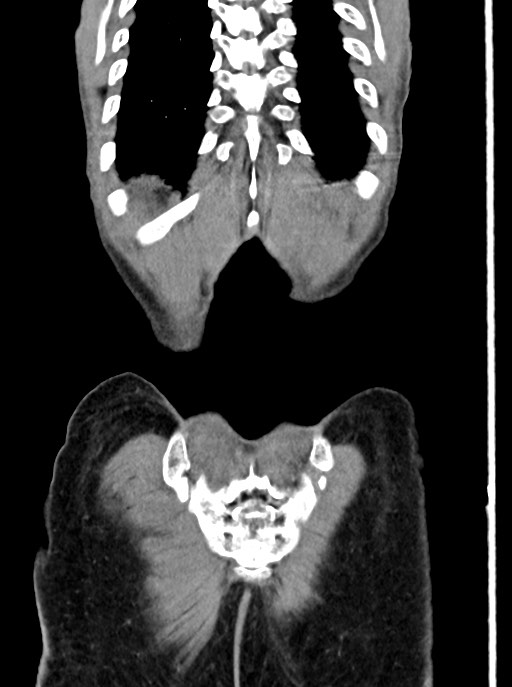 Acute small bowel (ileal) volvulus (Radiopaedia 71740-82139 Coronal C+ portal venous phase 103).jpg