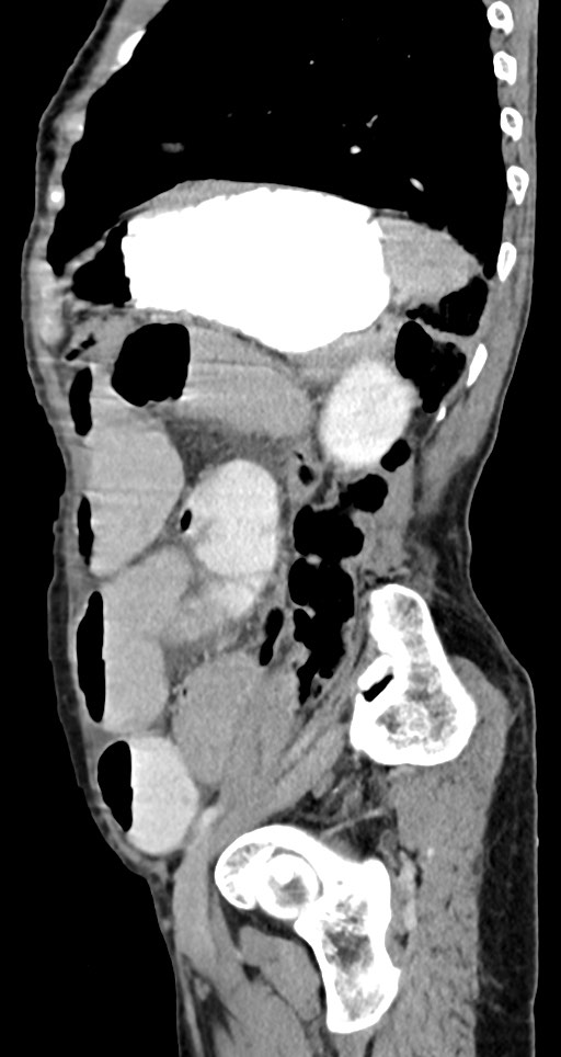 Acute small bowel (ileal) volvulus (Radiopaedia 71740-82139 Sagittal C+ portal venous phase 55).jpg