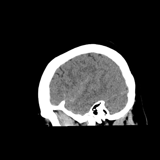 Acute subarachnoid hemorrhage and accessory anterior cerebral artery (Radiopaedia 69231-79008 Sagittal non-contrast 14).jpg