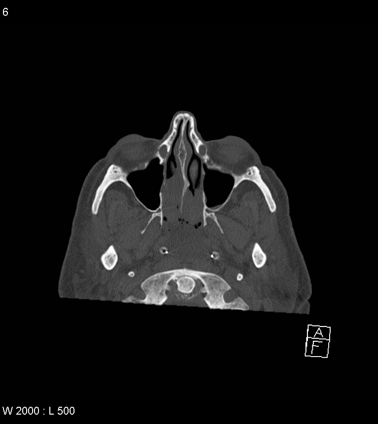 Acute subdural hematoma with myelofibrosis (Radiopaedia 52582-58494 Axial bone window 3).jpg