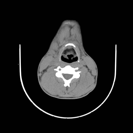 File:Acute submandibular sialadenitis secondary to ductal stone (Radiopaedia 27999-28267 Axial non-contrast 19).jpg