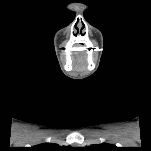 File:Acute submandibular sialadenitis secondary to ductal stone (Radiopaedia 27999-28267 Coronal C+ delayed 12).jpg