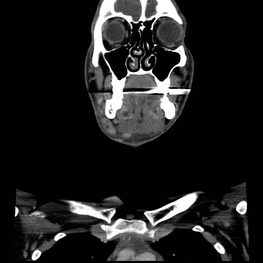 File:Acute submandibular sialadenitis secondary to ductal stone (Radiopaedia 27999-28267 D 17).jpg