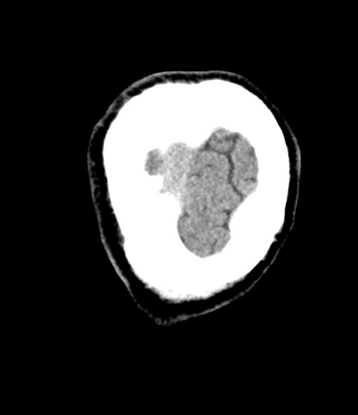 Acute superior cerebellar artery territory infarct (Radiopaedia 84104-99359 Coronal non-contrast 81).jpg