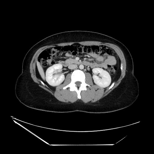 Acute uncomplicated appendicitis (Radiopaedia 73704-84499 Axial C+ portal venous phase 65).jpg