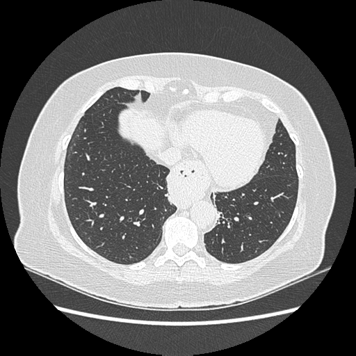 Adenocarcinoma in situ of lung (Radiopaedia 38685-40829 B 166).png