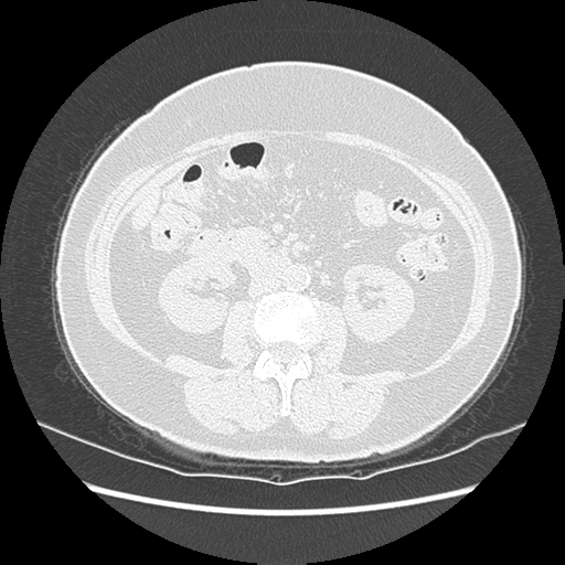 Adenocarcinoma in situ of lung (Radiopaedia 38685-40829 B 275).png