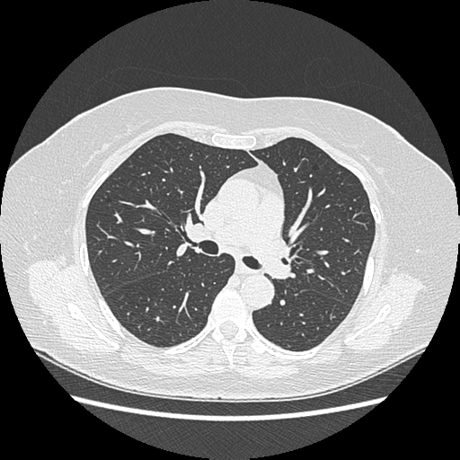 Adenocarcinoma in situ of lung (Radiopaedia 38685-40829 B 97).png