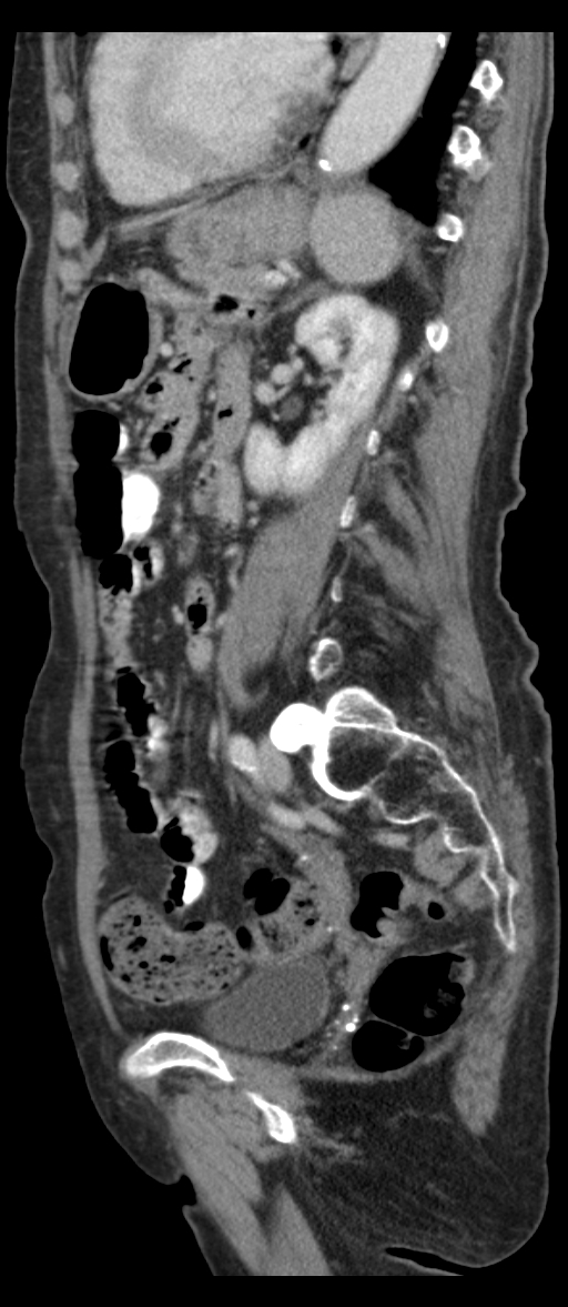 Adenocarcinoma of cecum (Radiopaedia 59222-66549 Sagittal C+ portal venous phase 31).jpg