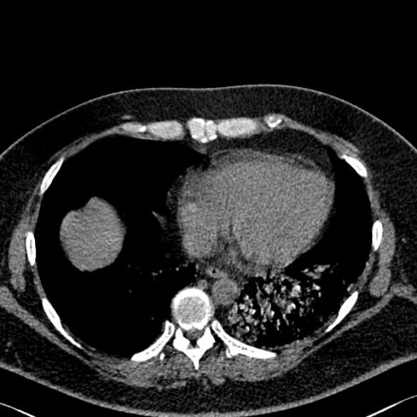 Adenoid cystic carcinoma of the trachea (Radiopaedia 49042-54137 Axial non-contrast 247).jpg