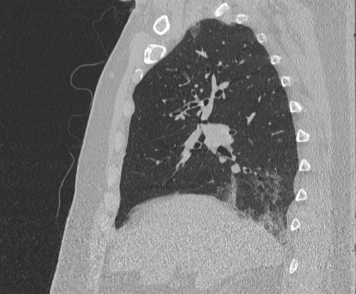Adenoid cystic carcinoma of the trachea (Radiopaedia 49042-54137 Sagittal lung window 170).jpg