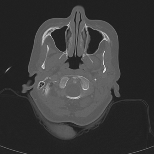 Adenoid cystic tumor of palate (Radiopaedia 46980-51518 Axial bone window 23).png