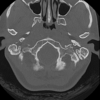 File:Adhesive chronic otitis media (Radiopaedia 14270-14148 Axial bone window 24).jpg