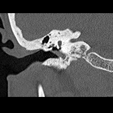 File:Adhesive chronic otitis media (Radiopaedia 14270-14148 Coronal bone window - right 12).jpg