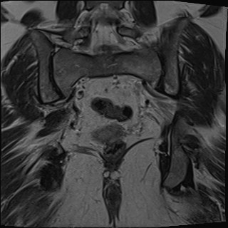 File:Adnexal multilocular cyst (O-RADS US 3- O-RADS MRI 3) (Radiopaedia 87426-103754 Coronal T2 24).jpg