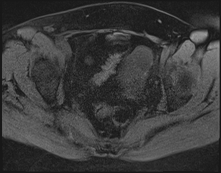 File:Adnexal multilocular cyst (O-RADS US 3. O-RADS MRI 3) (Radiopaedia 87426-103754 Axial 182).jpeg