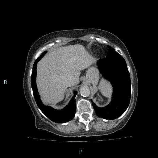 File:Adrenal collision tumor (ACT) (Radiopaedia 48462-53379 Axial C+ delayed 11).jpg