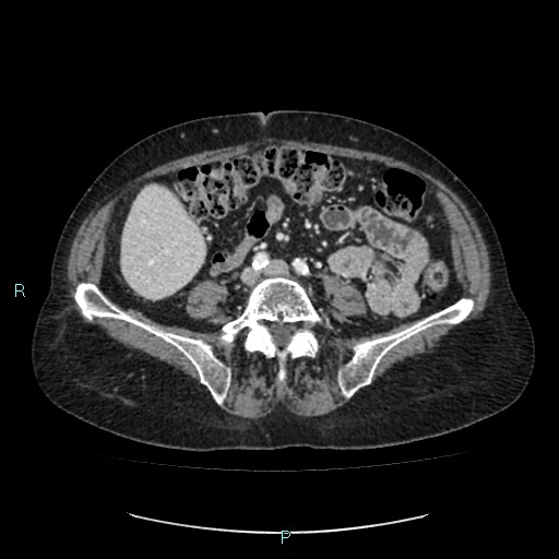 File:Adrenal collision tumor (ACT) (Radiopaedia 48462-53379 Axial C+ portal venous phase 38).jpg