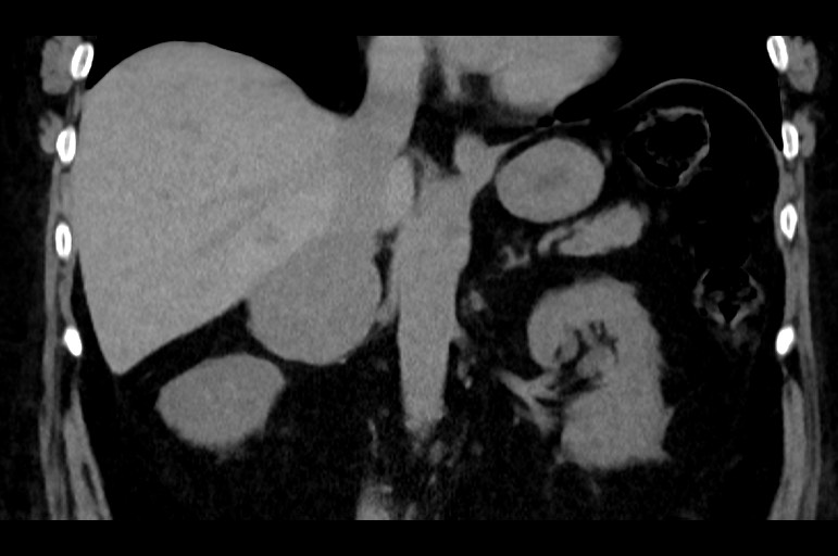 Adrenal cortical carcinoma (Radiopaedia 64017-72769 Coronal non-contrast 32).jpg
