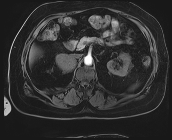 Adrenal cortical carcinoma (Radiopaedia 64017-72770 Axial T1 C+ fat sat 16).jpg