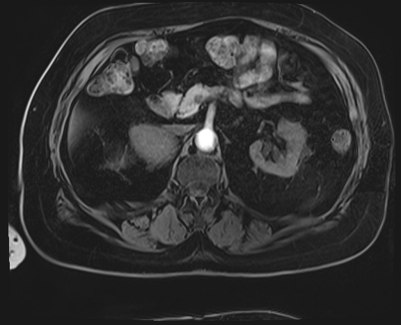 Adrenal cortical carcinoma (Radiopaedia 64017-72770 Axial T1 C+ fat sat 17).jpg