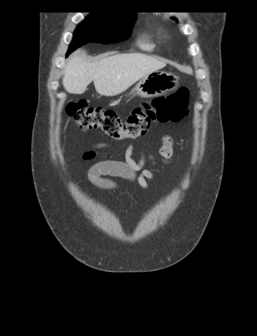 Adrenal cyst (Radiopaedia 45625-49777 Coronal C+ portal venous phase 15).png