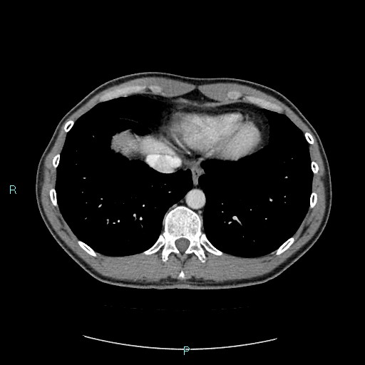 Adrenal cystic lymphangioma (Radiopaedia 83161-97534 Axial C+ portal venous phase 10).jpg