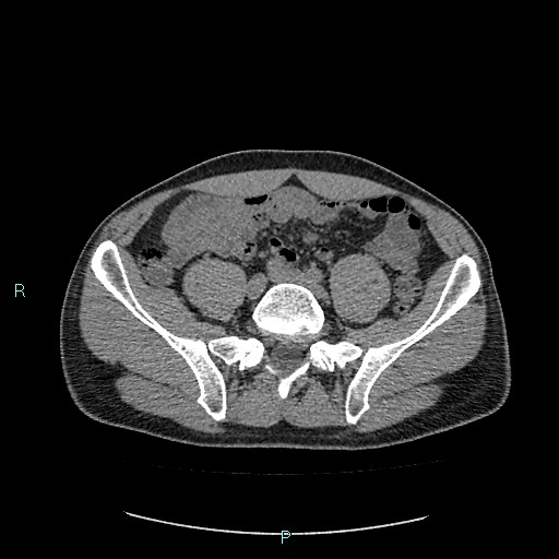 File:Adrenal cystic lymphangioma (Radiopaedia 83161-97534 Axial non-contrast 68).jpg
