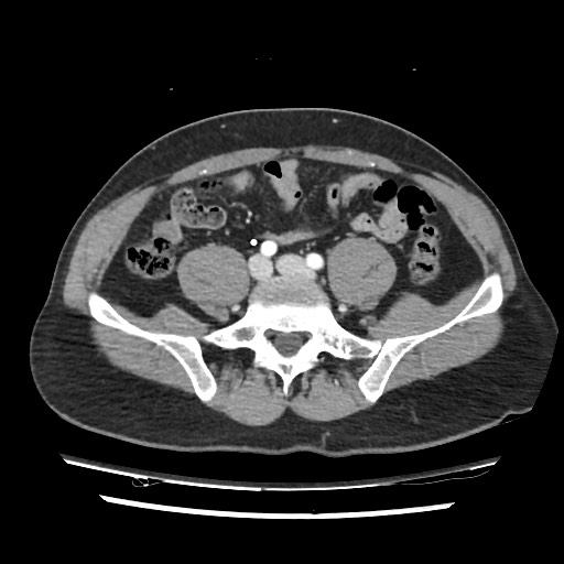 File:Adrenal gland trauma (Radiopaedia 81351-95078 Axial Dual bolus trauma C+ 95).jpg