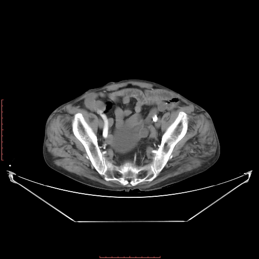Adrenal hemangioma (Radiopaedia 68923-78668 Axial C+ arterial phase 61).jpg