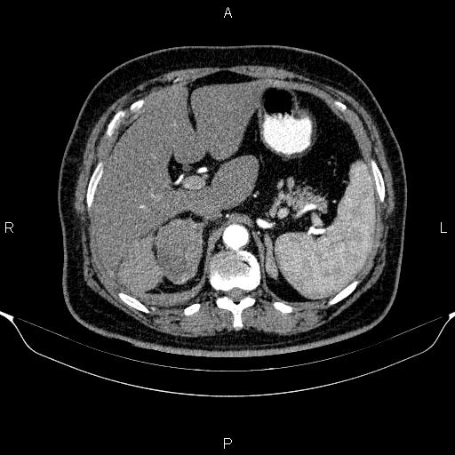 Adrenal hemorrhage (Radiopaedia 62622-70916 Axial C+ arterial phase 93).jpg