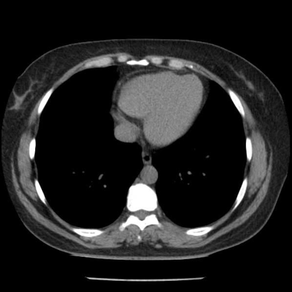 Adrenal myelolipoma (Radiopaedia 43401-46759 Axial non-contrast 3).jpg