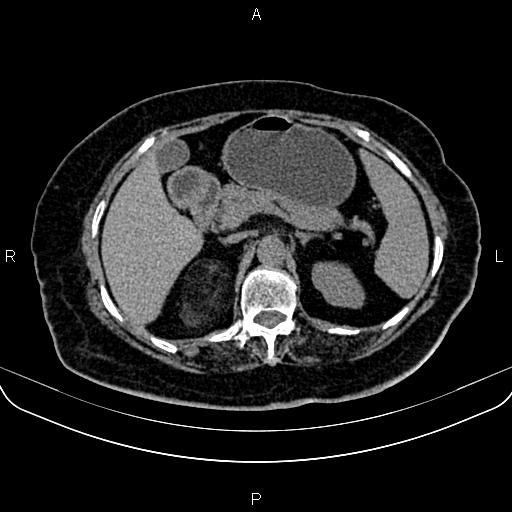 Adrenal myelolipoma (Radiopaedia 82742-96986 Axial non-contrast 46).jpg