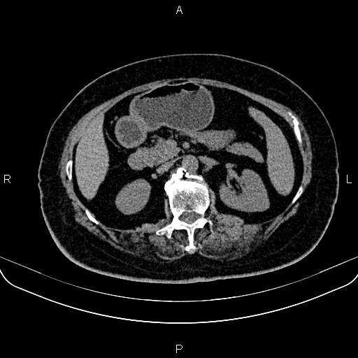 Adrenal myelolipoma (Radiopaedia 82742-96986 Axial non-contrast 60).jpg