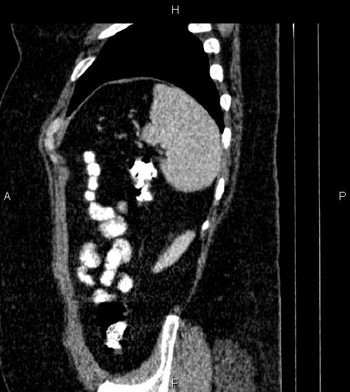 Adrenal myelolipoma (Radiopaedia 84319-99617 Sagittal renal cortical phase 83).jpg