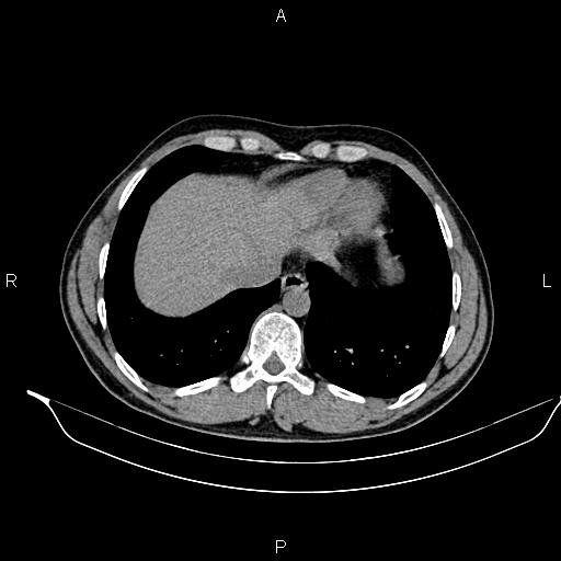 File:Adrenal myelolipoma (Radiopaedia 87794-104246 Axial non-contrast 14).jpg