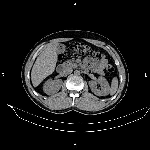File:Adrenal myelolipoma (Radiopaedia 87794-104246 Axial non-contrast 41).jpg