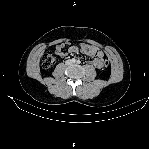 Adrenal myelolipoma (Radiopaedia 87794-104246 Axial renal cortical phase 61).jpg