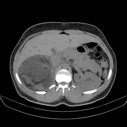 File:Adrenal myelolipoma - bilateral (Radiopaedia 74805-85810 Axial non-contrast 24).jpg