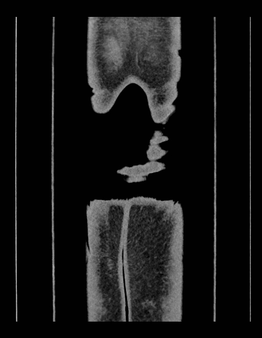 Adrenal myelolipoma - bilateral (Radiopaedia 74805-85810 Coronal C+ portal venous phase 26).jpg