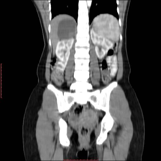 File:Adrenal pseudocyst (Radiopaedia 44419-48073 Coronal C+ portal venous phase 10).jpg