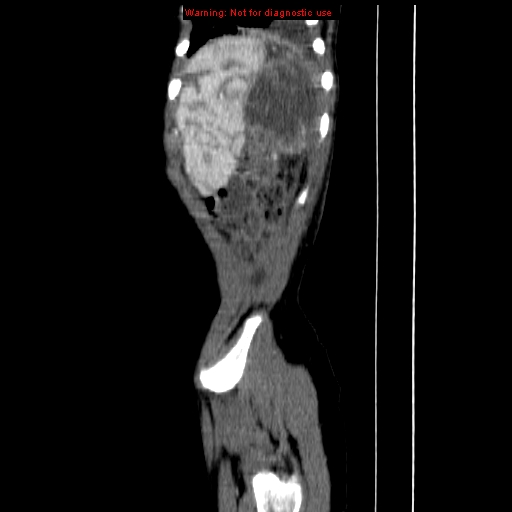 File:Adrenocortical carcinoma (Radiopaedia 9449-10131 Sagittal C+ portal venous phase 19).jpg