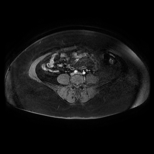 File:Adult granulosa cell tumor of the ovary (Radiopaedia 64991-73953 axial-T1 Fat sat post-contrast dynamic 41).jpg