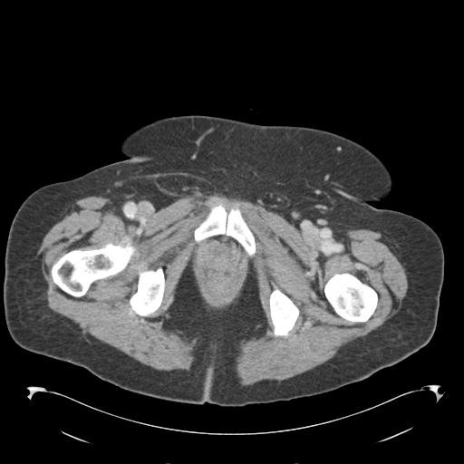 Adult ileal intussusception with secondary obstruction (Radiopaedia 30395-31051 Axial C+ portal venous phase 80).jpg