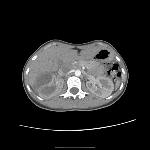 Adult polycystic kidney disease (Radiopaedia 48845-53876 Axial renal cortical phase 18).jpg